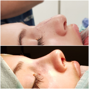 Rinoplastia