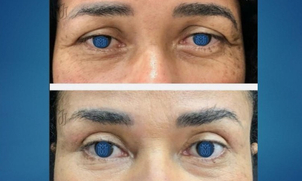 Rejuvenece la mirada con blefaroplastia
