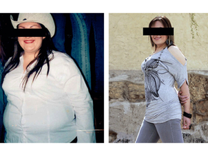 antes y después balón gástrico