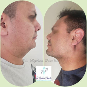 ¿Qué es la cirugía de papada?