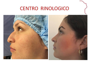 Antes y después de Rinoplastia