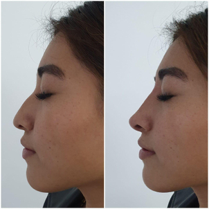 Resultados rinomodelación