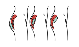 Técnicas de implantes de glúteos