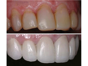 antes y después blanqueamiento dental