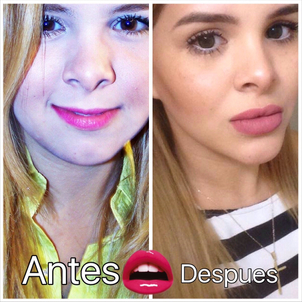 Antes y después aumento de labios