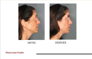 Resultados de manchas en la piel