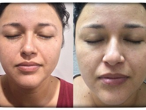 Antes y después peeling