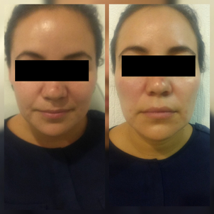 Ventajas de los hilos tensores