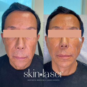 ¿Qué son los hilos tensores?