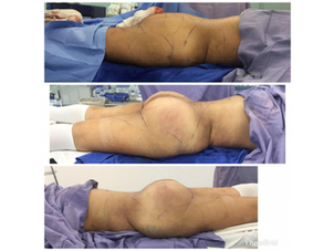 Postoperatorio del aumento de glúteos