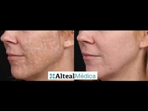 Tipos de peeling