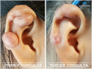Antes y después de la cirugia