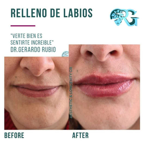 Primera cita aumento labios