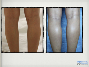 Antes y después aumento chamorros