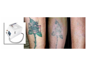 Antes y después de eliminar tatuaje