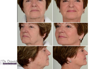 tratamientos de rejuvenecimiento