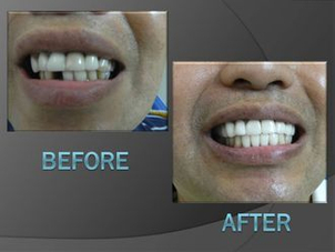 antes y después implantes