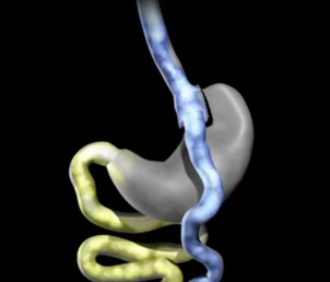 ¿Qué es el bypass gástrico?