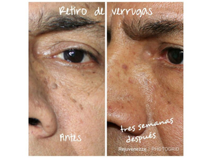 cicatriz de eliminación de verrugas