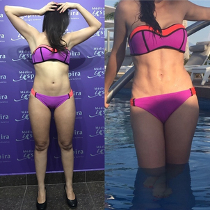 mommy makeover resultados