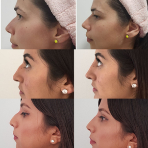 Beneficios rinomodelación