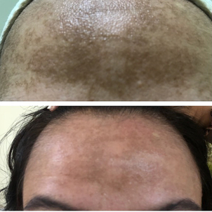 Resultados plasma rico en plaquetas