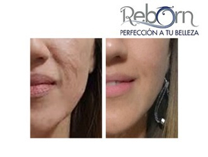 Antes y después peeling