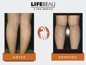 Antes y después aumento pantorrillas