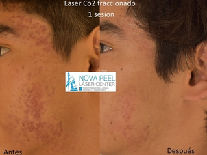 Antes y después. Láser CO2 fraccionado