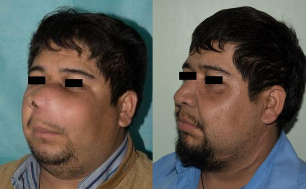 Antes y después de una cirugía reconstructiva 