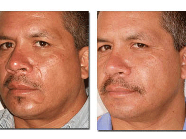 Antes y después de la cirugía para cicatriz