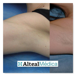 Antes y después depilación láser