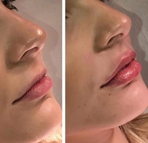 Resultados aumento de labios