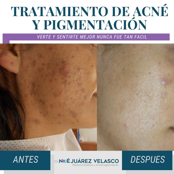 Resultados tratamiento de acné