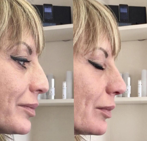 Antes y después de rinomodelación