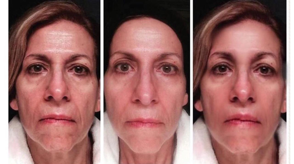 Antes y después de rejuvenecimiento facial 