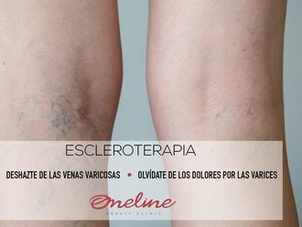 Antes y después tratamiento varices