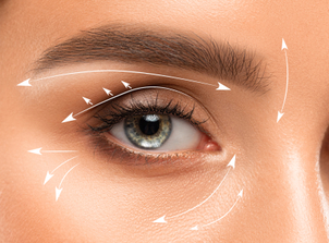 Otras técnicas utilizadas para la blefaroplastia sin cirugía