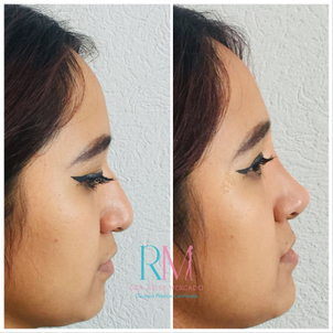 Antes y después de la rinomodelación