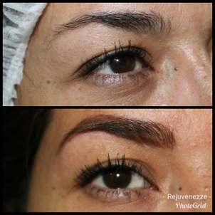 antes y después de microblanding