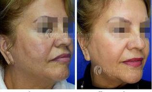 Resultados de los hilos tensores