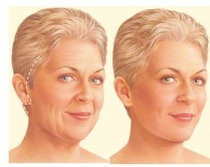 ¿Qué una cirugía facial?