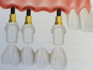 Implantes dentales