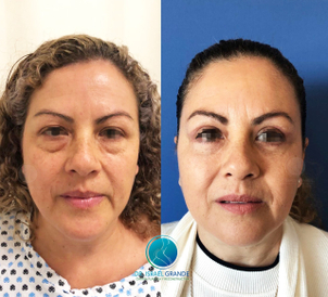 rejuvenecimiento facial