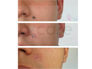 cuidados eliminación de lunares