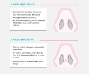 Rinoplastia