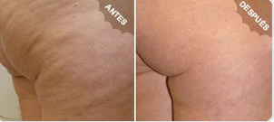 tratamiento anti-estrías