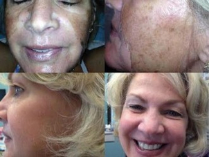 Antes y después peeling