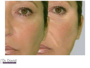 Rejuvenecimiento facial