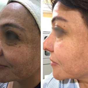 Primera consulta Plasma